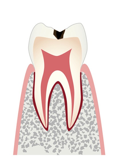 c1エナメル質に小さな穴が空いたむし歯