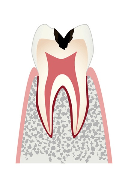 c2歯の内部（象牙質）まで進行したむし歯