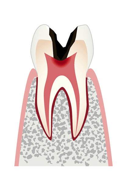 c3神経まで進行したむし歯